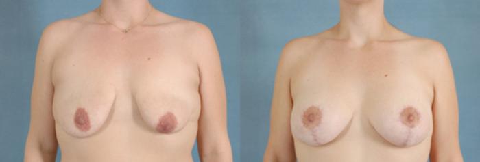 Before & After Breast Lift (Mastopexy) with Implants Case 221 View #1 View in Tallahassee, FL