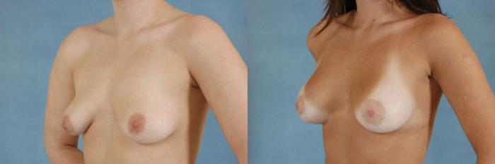 Before & After Breast Lift (Mastopexy) with Implants Case 222 View #2 View in Tallahassee, FL