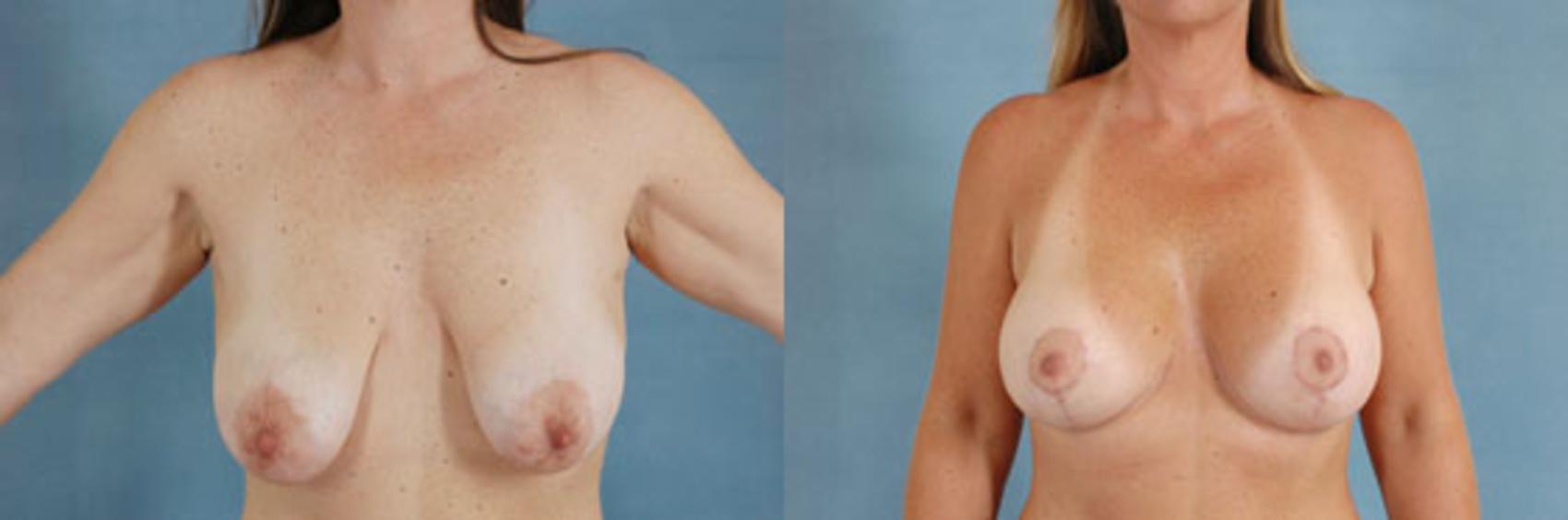 Before & After Breast Lift (Mastopexy) with Implants Case 223 View #1 View in Tallahassee, FL