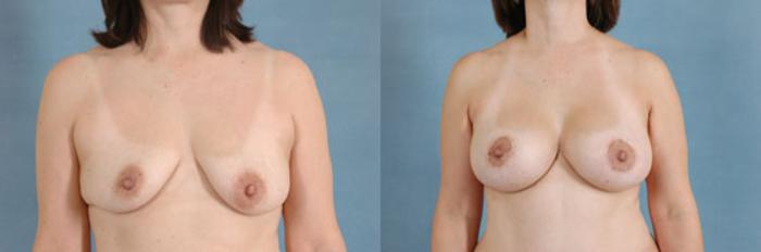 Before & After Breast Lift (Mastopexy) with Implants Case 224 View #1 View in Tallahassee, FL