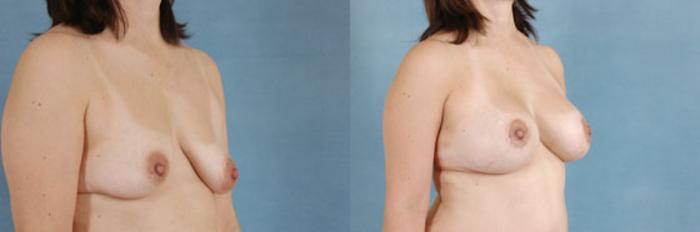 Before & After Breast Lift (Mastopexy) with Implants Case 224 View #2 View in Tallahassee, FL