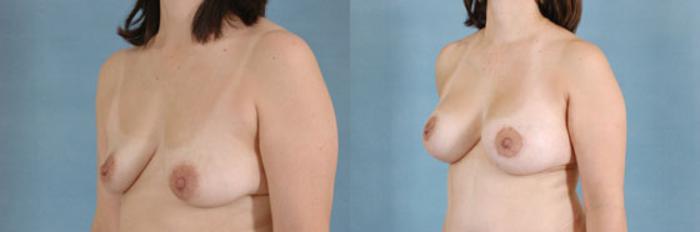 Before & After Breast Lift (Mastopexy) with Implants Case 224 View #3 View in Tallahassee, FL