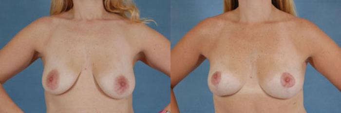 Before & After Breast Lift (Mastopexy) with Implants Case 225 View #1 View in Tallahassee, FL