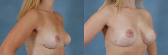 Before & After Breast Lift (Mastopexy) with Implants Case 225 View #4 View in Tallahassee, FL