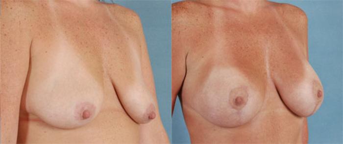 Before & After Breast Lift (Mastopexy) with Implants Case 226 View #2 View in Tallahassee, FL
