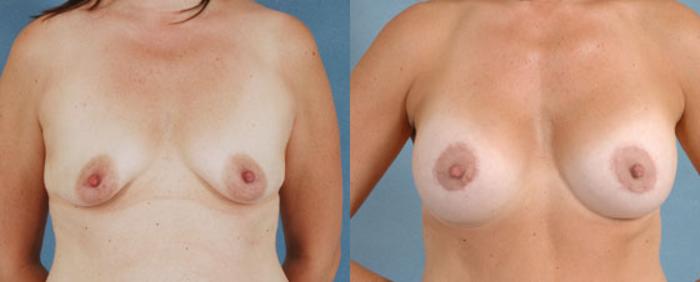 Before & After Breast Lift (Mastopexy) with Implants Case 227 View #1 View in Tallahassee, FL