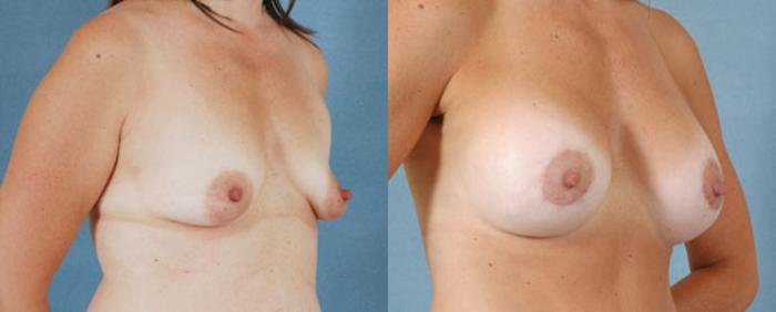 Before & After Breast Lift (Mastopexy) with Implants Case 227 View #2 View in Tallahassee, FL