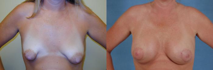 Before & After Breast Lift (Mastopexy) with Implants Case 229 View #1 View in Tallahassee, FL