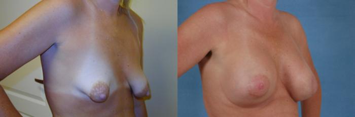 Before & After Breast Lift (Mastopexy) with Implants Case 229 View #2 View in Tallahassee, FL