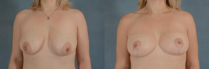 Before & After Breast Lift (Mastopexy) with Implants Case 230 View #1 View in Tallahassee, FL