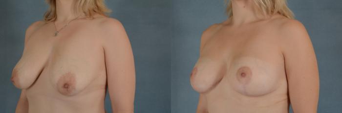 Before & After Breast Lift (Mastopexy) with Implants Case 230 View #2 View in Tallahassee, FL