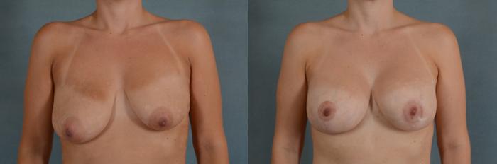 Before & After Breast Lift (Mastopexy) with Implants Case 231 View #1 View in Tallahassee, FL
