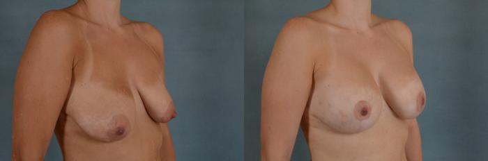 Before & After Breast Lift (Mastopexy) with Implants Case 231 View #2 View in Tallahassee, FL