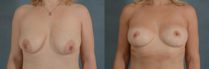 Before & After Breast Lift (Mastopexy) with Implants Case 232 View #1 View in Tallahassee, FL