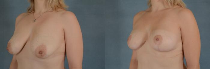Before & After Breast Lift (Mastopexy) with Implants Case 232 View #2 View in Tallahassee, FL