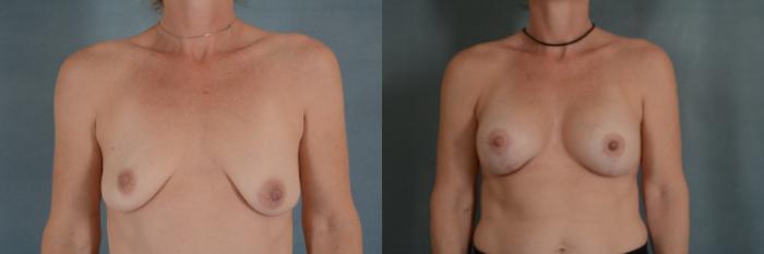 Before & After Breast Lift (Mastopexy) with Implants Case 299 View #1 View in Tallahassee, FL
