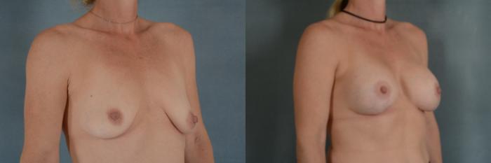 Before & After Breast Lift (Mastopexy) with Implants Case 299 View #2 View in Tallahassee, FL