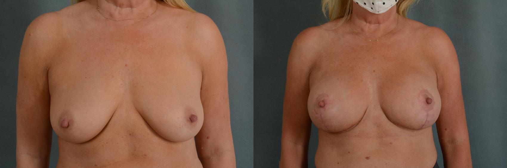 Before & After Breast Lift (Mastopexy) with Implants Case 340 View #1 View in Tallahassee, FL