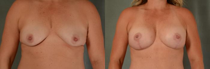 Before & After Breast Lift (Mastopexy) with Implants Case 416 View #1 View in Tallahassee, FL