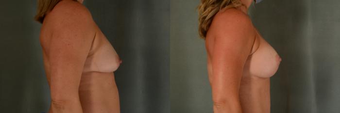 Before & After Breast Lift (Mastopexy) with Implants Case 416 View #2 View in Tallahassee, FL
