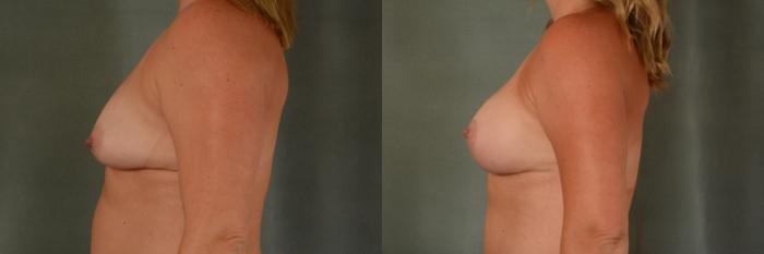 Before & After Breast Lift (Mastopexy) with Implants Case 416 View #3 View in Tallahassee, FL
