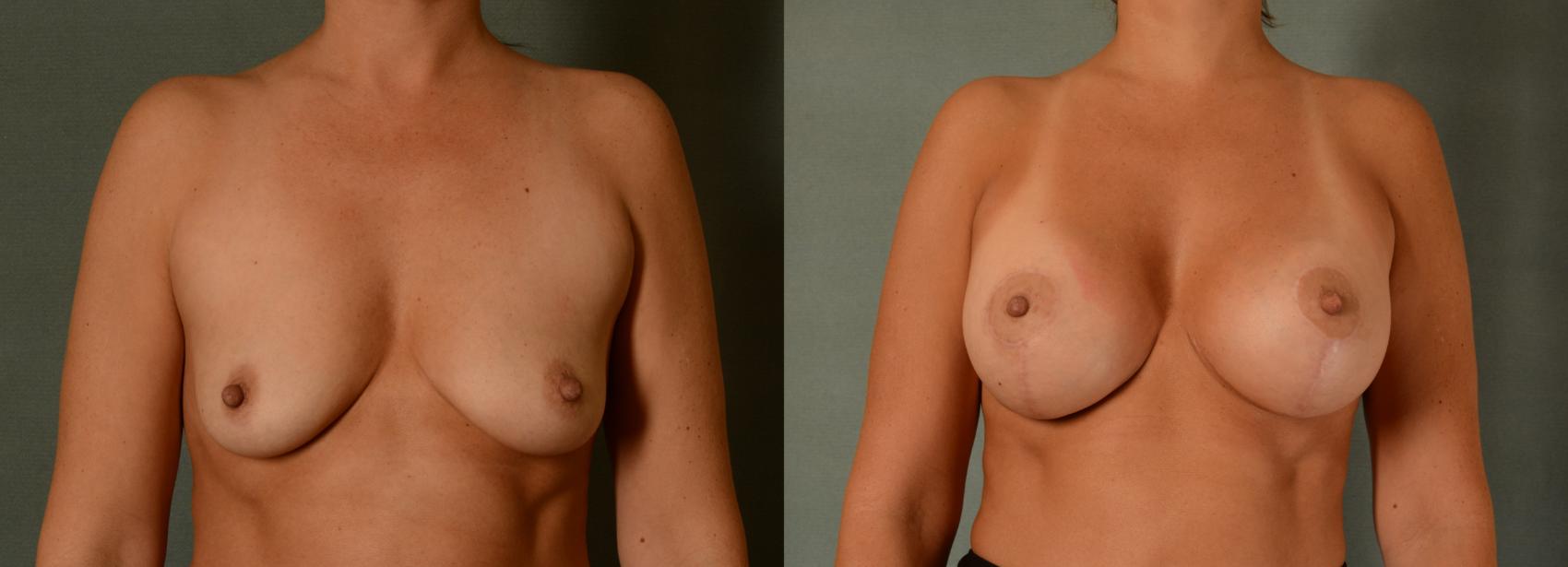 Before & After Breast Lift (Mastopexy) with Implants Case 435 View #1 View in Tallahassee, FL