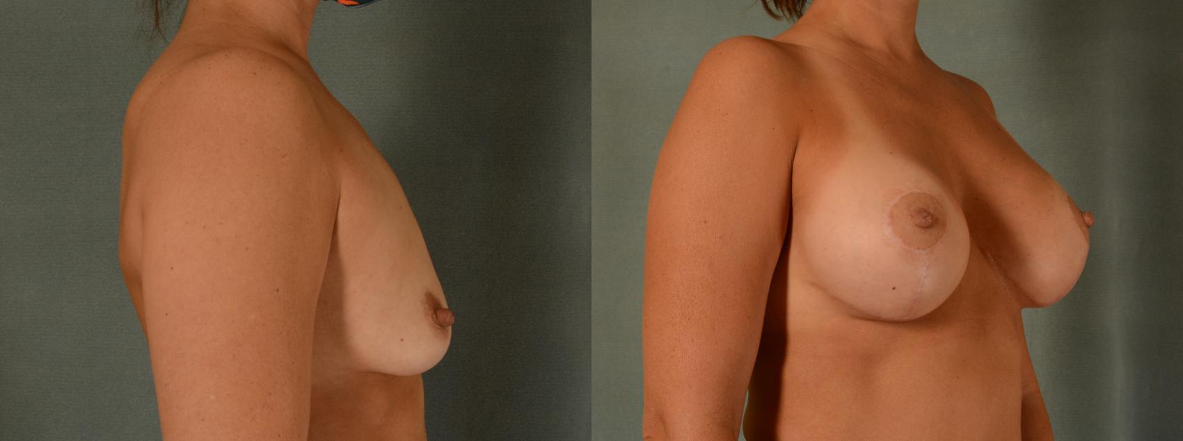 Before & After Breast Lift (Mastopexy) with Implants Case 435 View #2 View in Tallahassee, FL