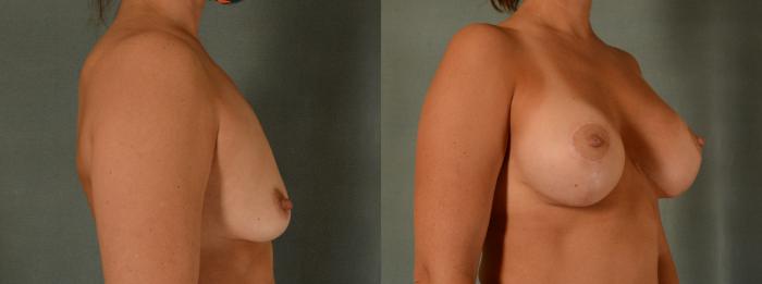 Before & After Breast Lift (Mastopexy) with Implants Case 435 View #2 View in Tallahassee, FL