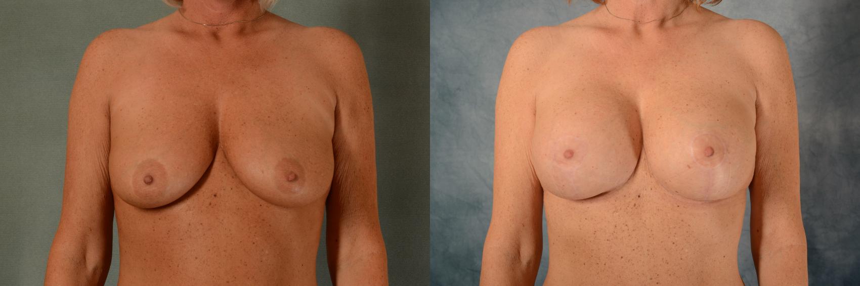 Before & After Breast Lift (Mastopexy) with Implants Case 461 Front View in Tallahassee, FL