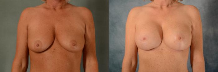 Before & After Breast Lift (Mastopexy) with Implants Case 461 Front View in Tallahassee, FL