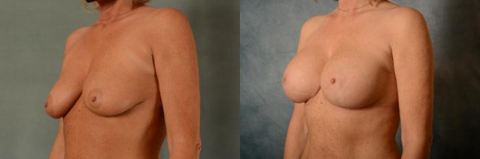 Before & After Breast Lift (Mastopexy) with Implants Case 461 Left Side View in Tallahassee, FL