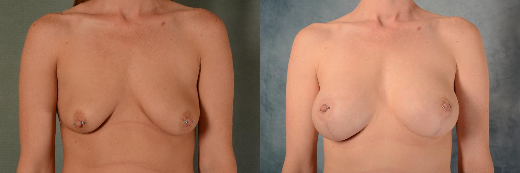 Before & After Breast Lift (Mastopexy) with Implants Case 467 Front View in Tallahassee, FL