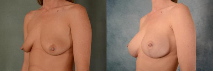 Before & After Breast Lift (Mastopexy) with Implants Case 467 Left Oblique View in Tallahassee, FL