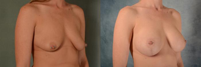 Before & After Breast Lift (Mastopexy) with Implants Case 467 Right Oblique View in Tallahassee, FL