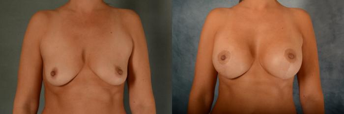 Before & After Breast Lift (Mastopexy) with Implants Case 477 Front View in Tallahassee, FL