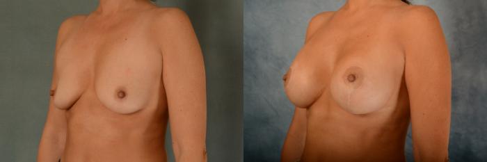 Before & After Breast Lift (Mastopexy) with Implants Case 477 Left Oblique View in Tallahassee, FL