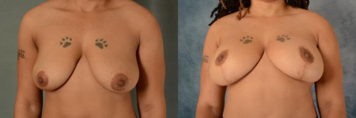 Before & After Breast Lift (Mastopexy) with Implants Case 478 Front View in Tallahassee, FL
