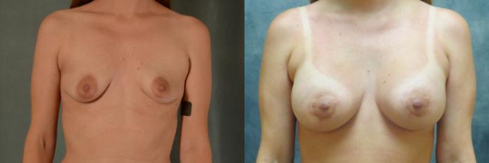 Before & After Breast Lift (Mastopexy) with Implants Case 510 Front View in Tallahassee, FL