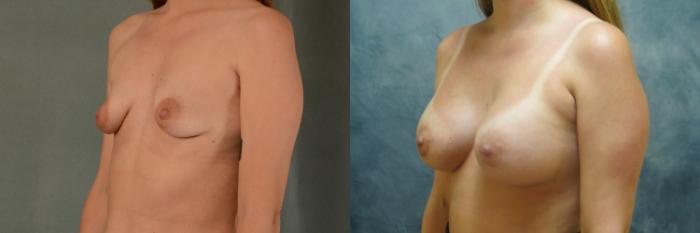 Before & After Breast Lift (Mastopexy) with Implants Case 510 Left Oblique View in Tallahassee, FL