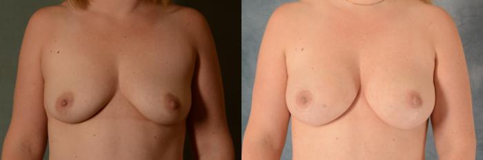 Before & After Breast Lift (Mastopexy) with Implants Case 525 Front View in Tallahassee, FL