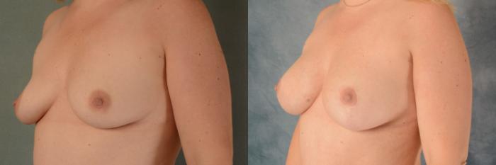 Before & After Breast Lift (Mastopexy) with Implants Case 525 Left Oblique View in Tallahassee, FL