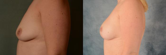 Before & After Breast Lift (Mastopexy) with Implants Case 525 Left Side View in Tallahassee, FL