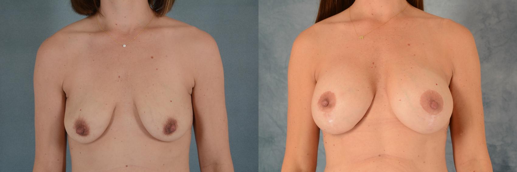 Before & After Breast Lift (Mastopexy) with Implants Case 595 Front View in Tallahassee, FL