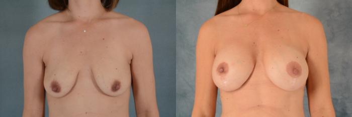 Before & After Breast Lift (Mastopexy) with Implants Case 595 Front View in Tallahassee, FL