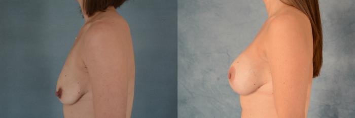 Before & After Breast Lift (Mastopexy) with Implants Case 595 Left Side View in Tallahassee, FL