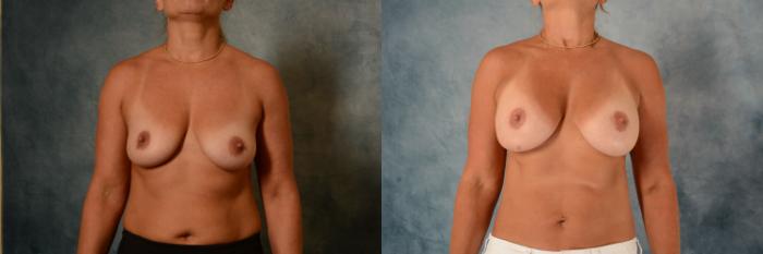 Before & After Liposuction Case 596 Front View in Tallahassee, FL