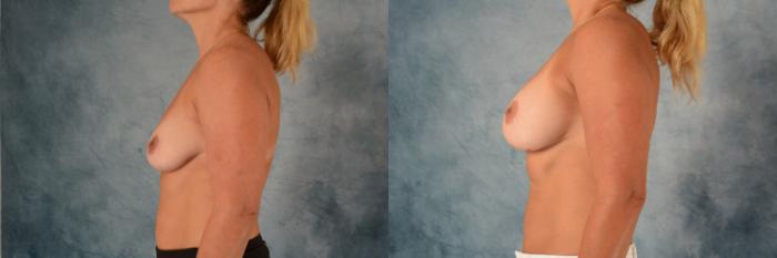 Before & After Liposuction Case 596 Left Side View in Tallahassee, FL