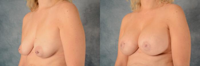 Before & After Breast Lift (Mastopexy) with Implants Case 598 Left Oblique View in Tallahassee, FL