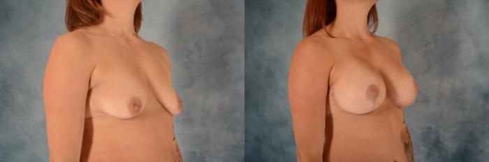 Before & After Breast Lift (Mastopexy) with Implants Case 622 Right Oblique View in Tallahassee, FL