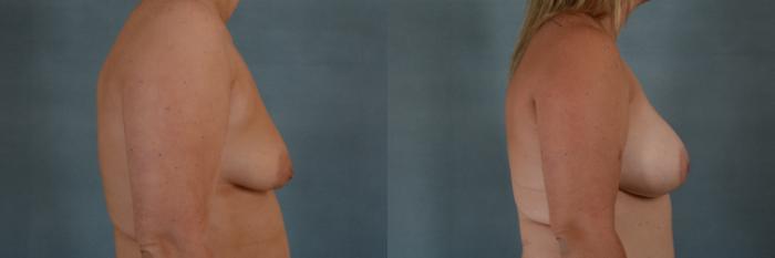 Before & After Breast Lift (Mastopexy) with Implants Case 629 Right Side View in Tallahassee, FL